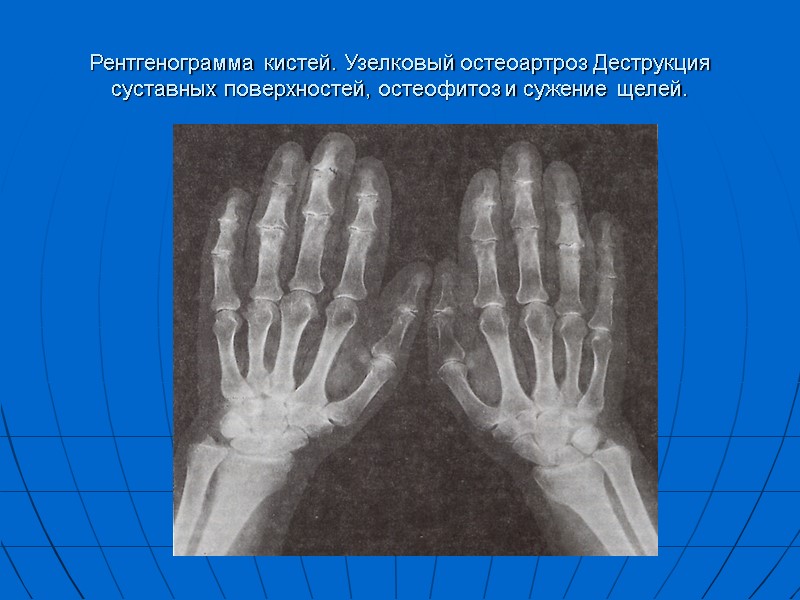 Рентгенограмма кистей. Узелковый остеоартроз Деструкция суставных поверхностей, остеофитоз и сужение щелей.